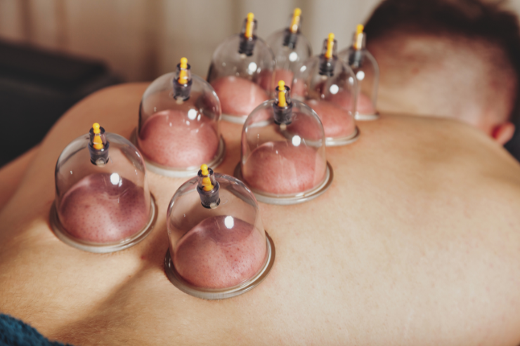 Cupping Therapy